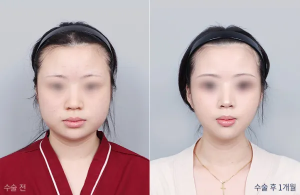 Before/After