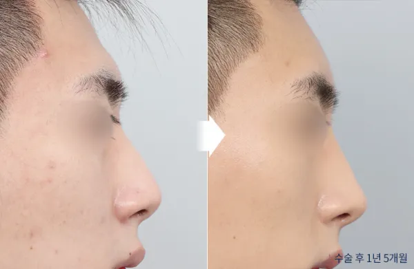 Before/After
