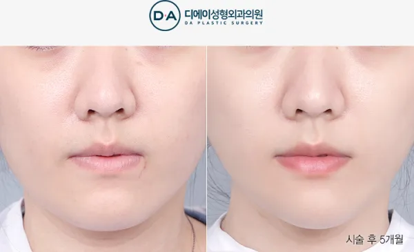 Before/After