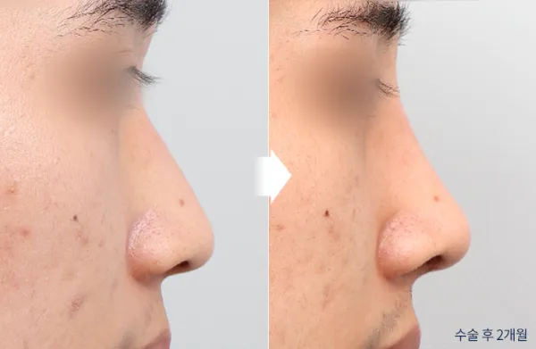 Before/After