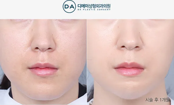 Before/After