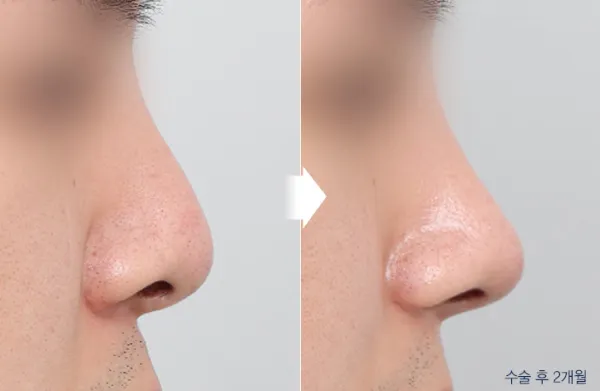 Before/After