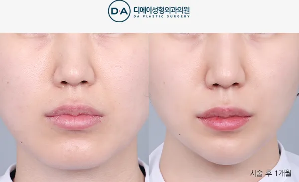 Before/After