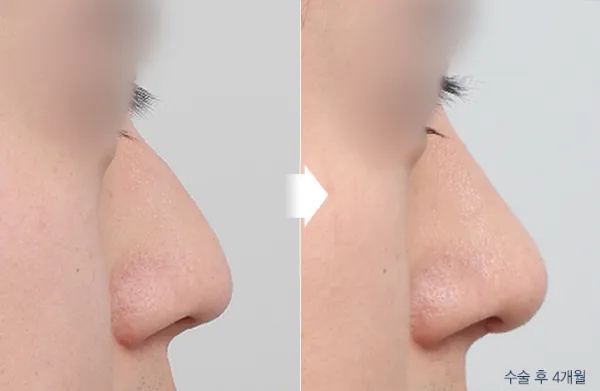 Before/After