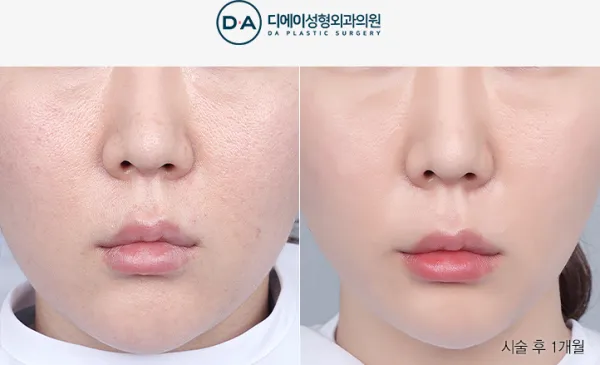 Before/After