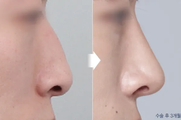 Before/After