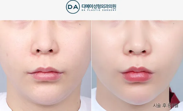 Before/After