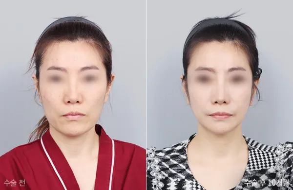 Before/After