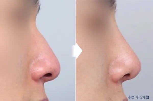 Before/After