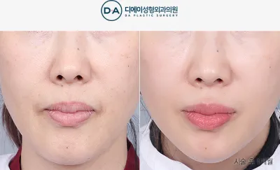 Before & After