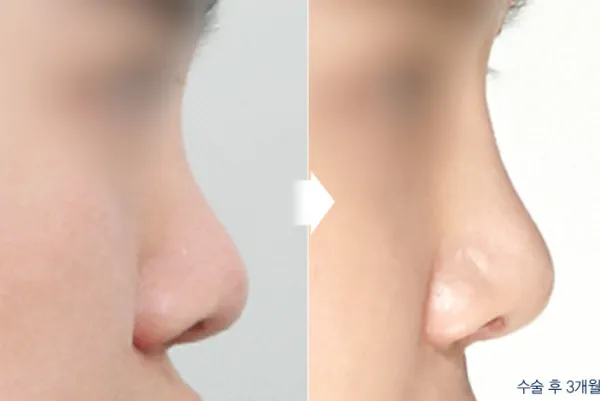 Before/After