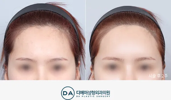 Before/After