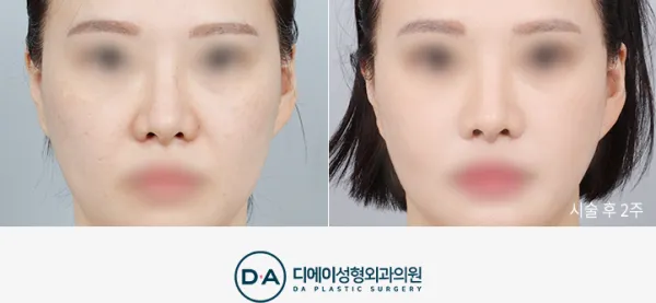 Before/After