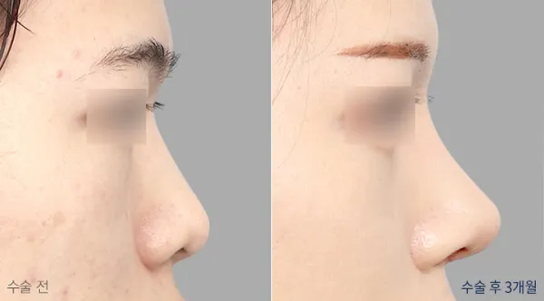 Before/After