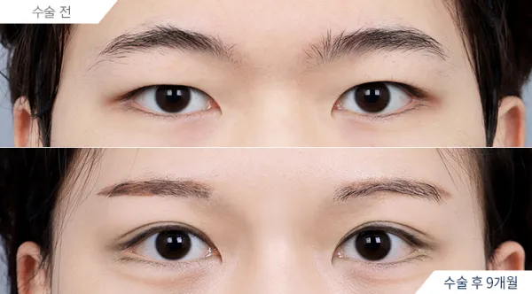 Before/After