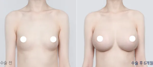 Before/After