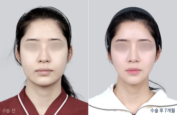 Before/After