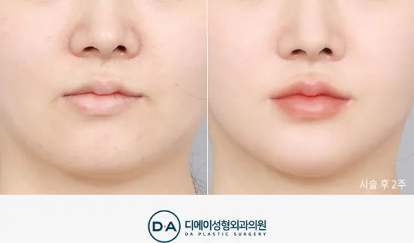 Before/After