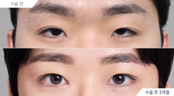 Before/After
