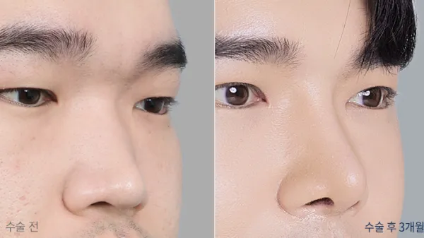Before/After