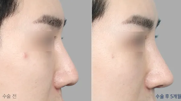 Before/After