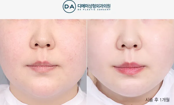 Before/After