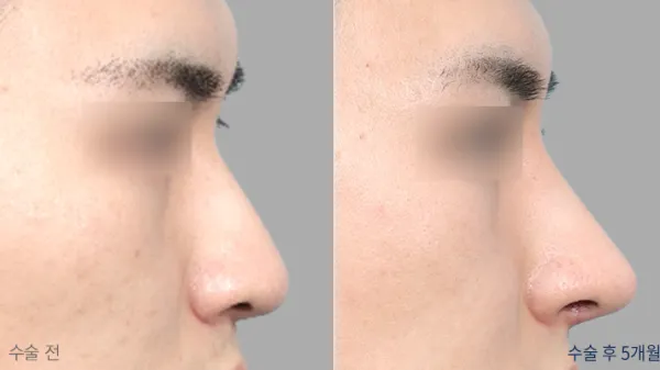 Before/After