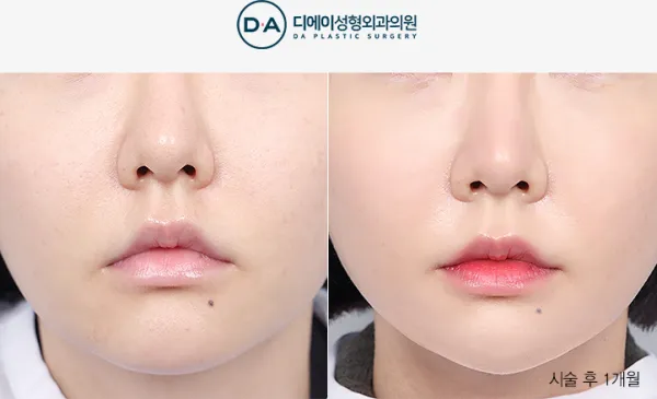 Before/After