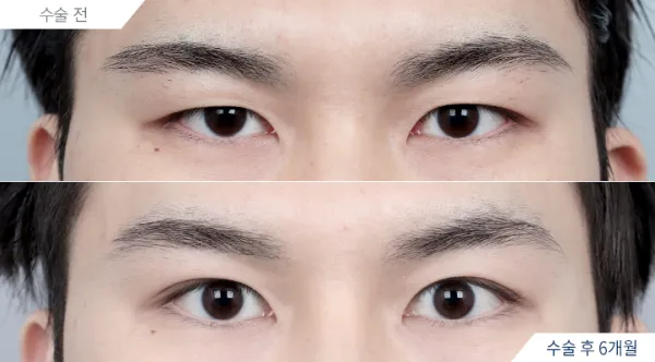 Before/After