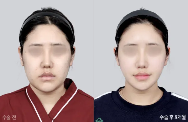 Before/After