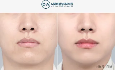 Before & After