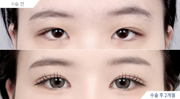 Before/After