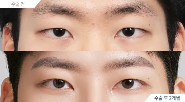 Before/After