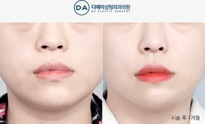 Before & After