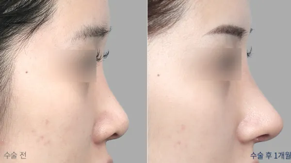 Before/After