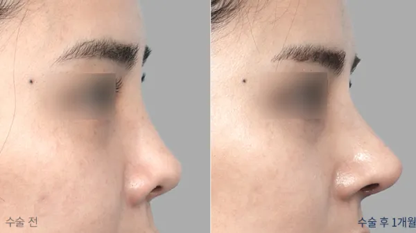 Before/After