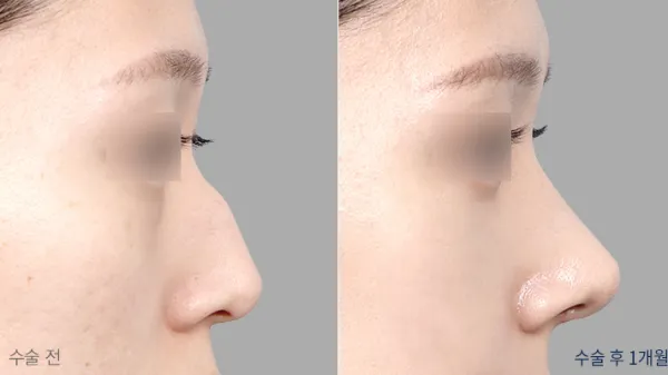Before/After