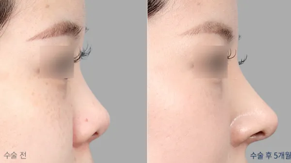 Before/After