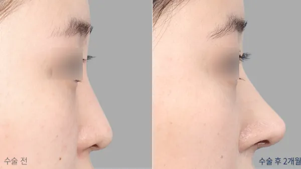 Before/After