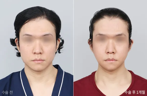 Before/After
