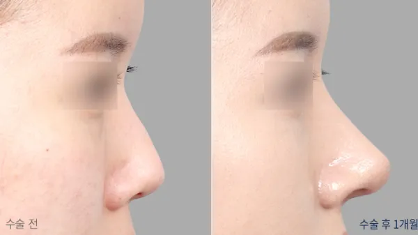 Before/After