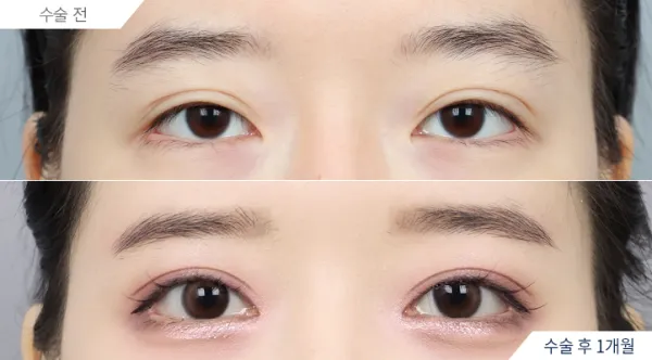 Before/After