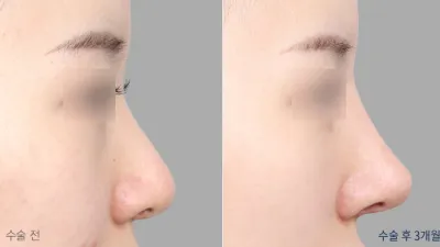 Before & After