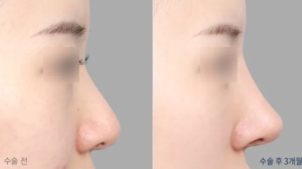 Before/After