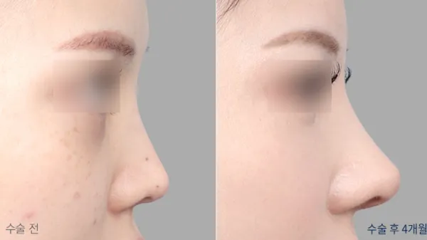 Before/After