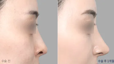 Before & After