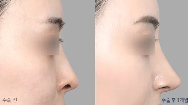 Before/After