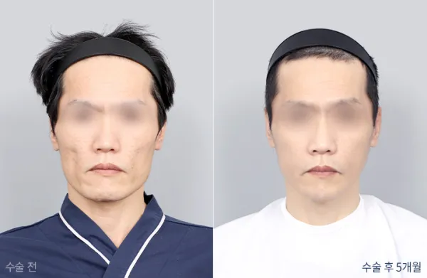 Before/After