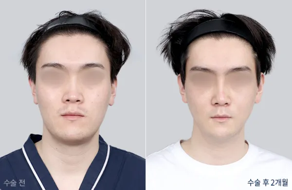 Before/After