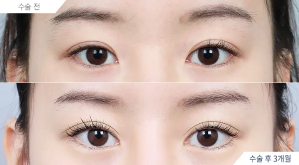 Before/After